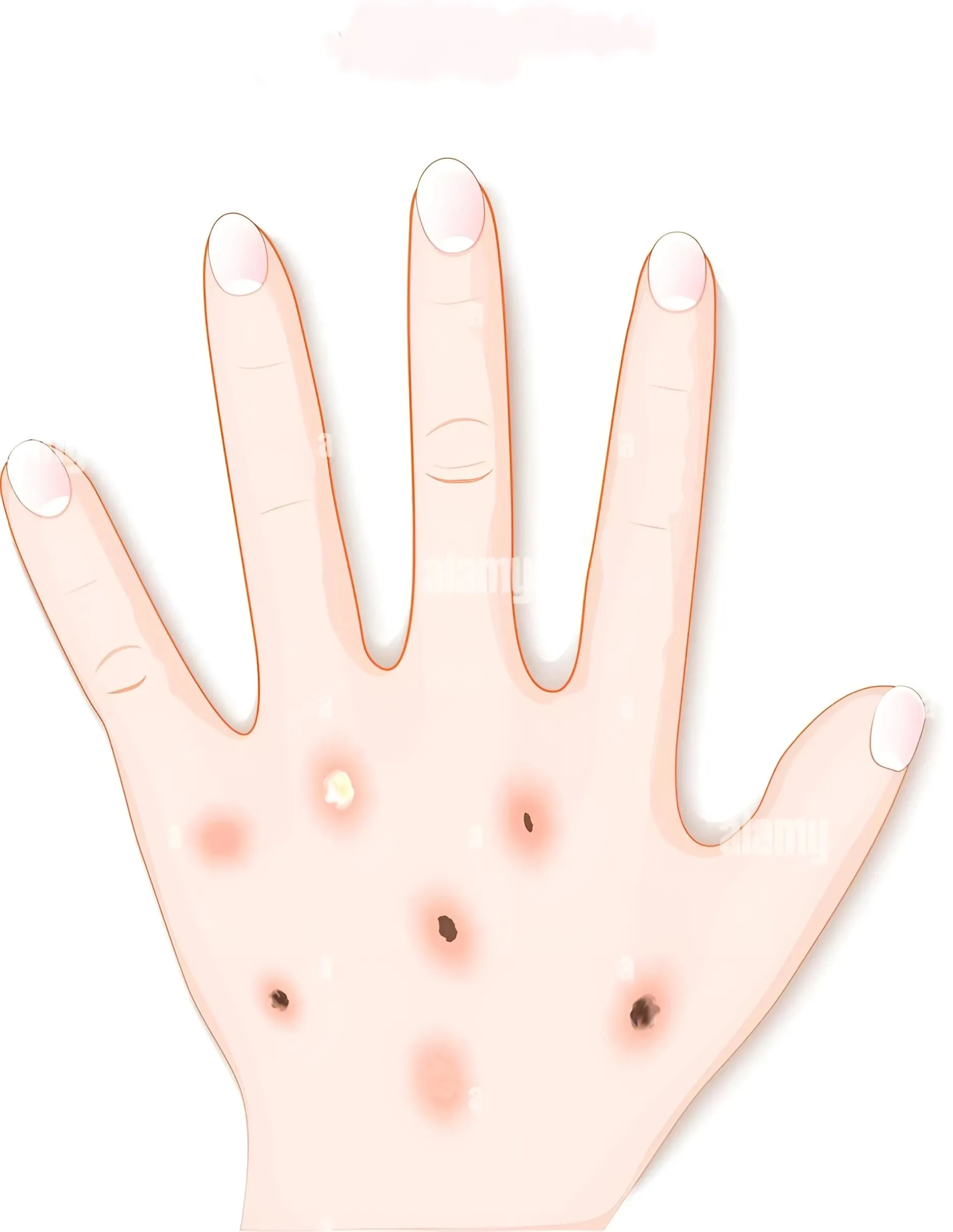 What is Actinic Keratosis (AK)?