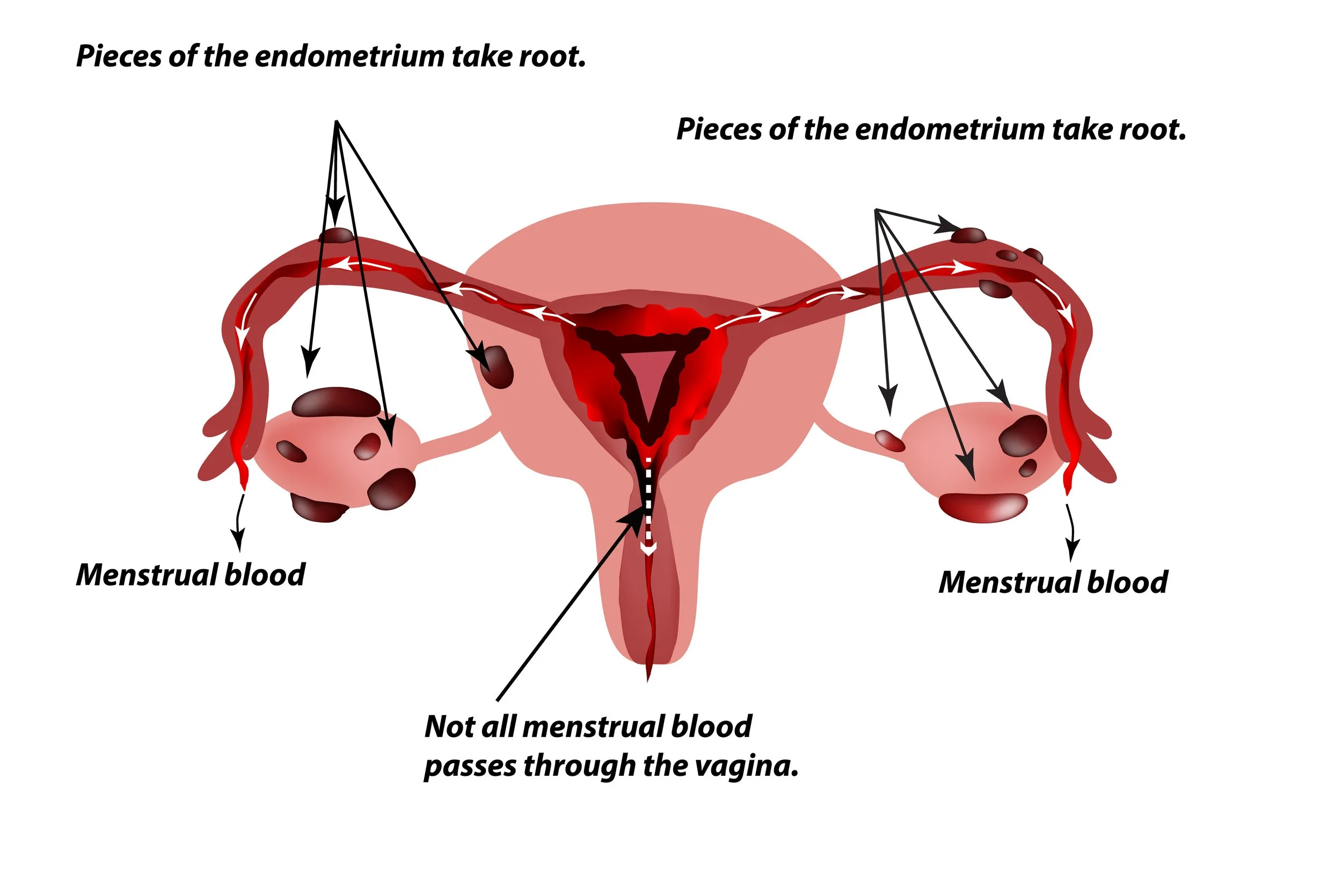 20 Symptoms of Endometriosis: Understanding the Signs